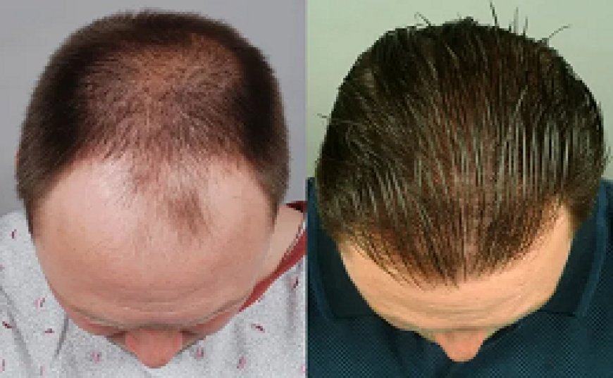 Hair transplant in Buraydah Lifestyle Tips to Maintain Results