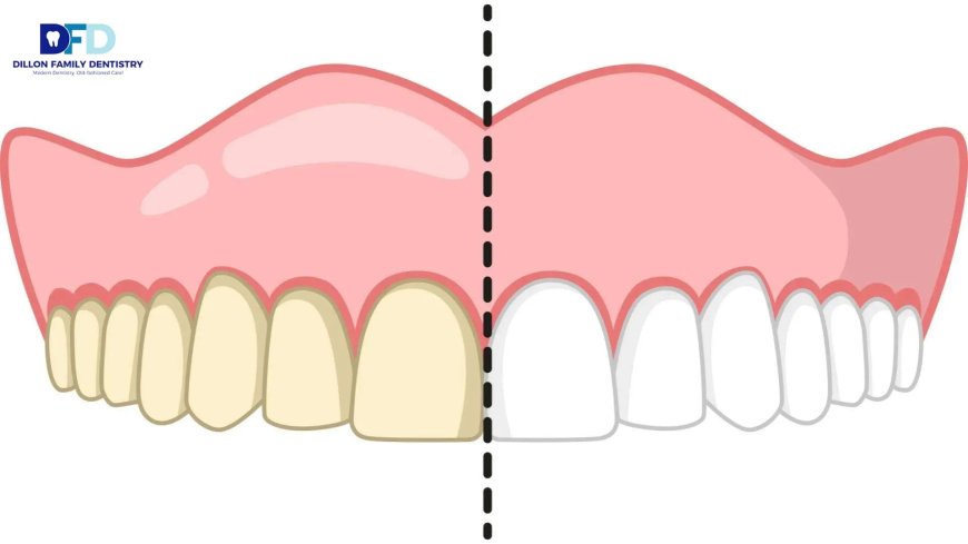 Teeth Whitening Sensitivity: Is It Permanent? | Bryn Mawr