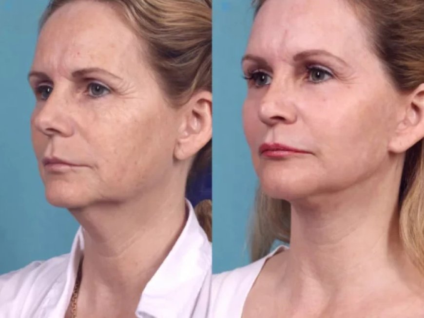 Best Plastic Surgeons in dubai Share the Complete Chemical Peel Journey