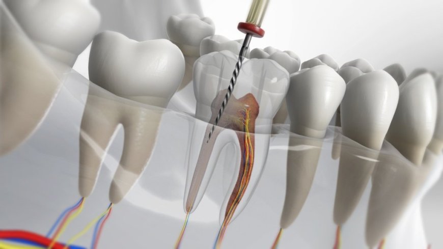 Key Factors Influencing Root Canal Treatment Cost in Parel Mumbai You Should Know