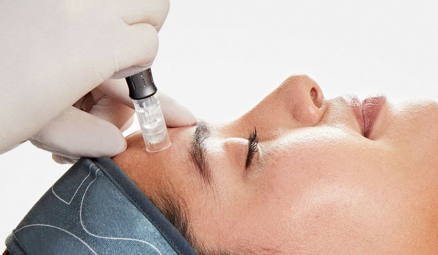 What does Microneedling do to the skin?