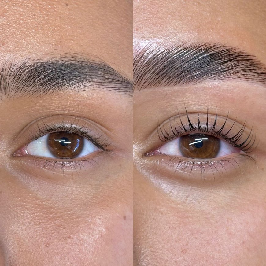 Eyelash Hair Transplant in Dubai: Proven Medical Results