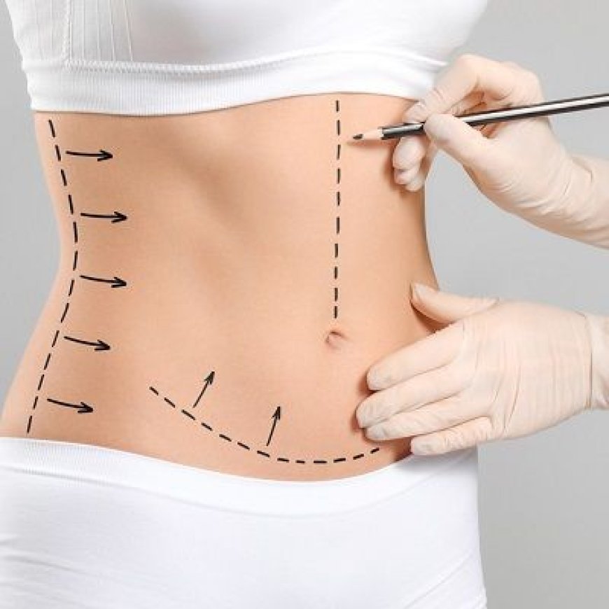 Tummy Tuck in Dubai: Addressing Excess Skin and Muscle Laxity