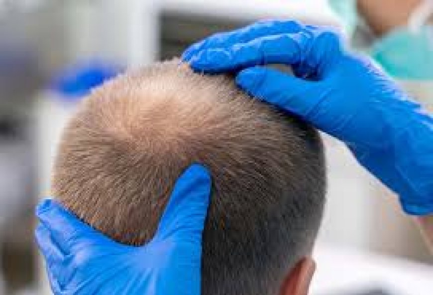 كل ما يجب معرفته عن زراعة الشعر في الدمام