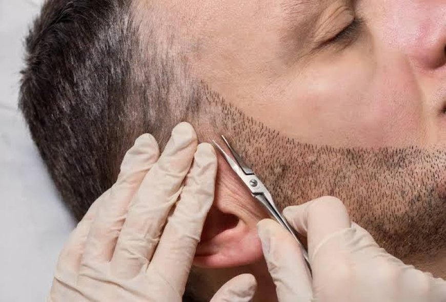 Post-Procedure Care After Beard Hair Transplant in Riyadh