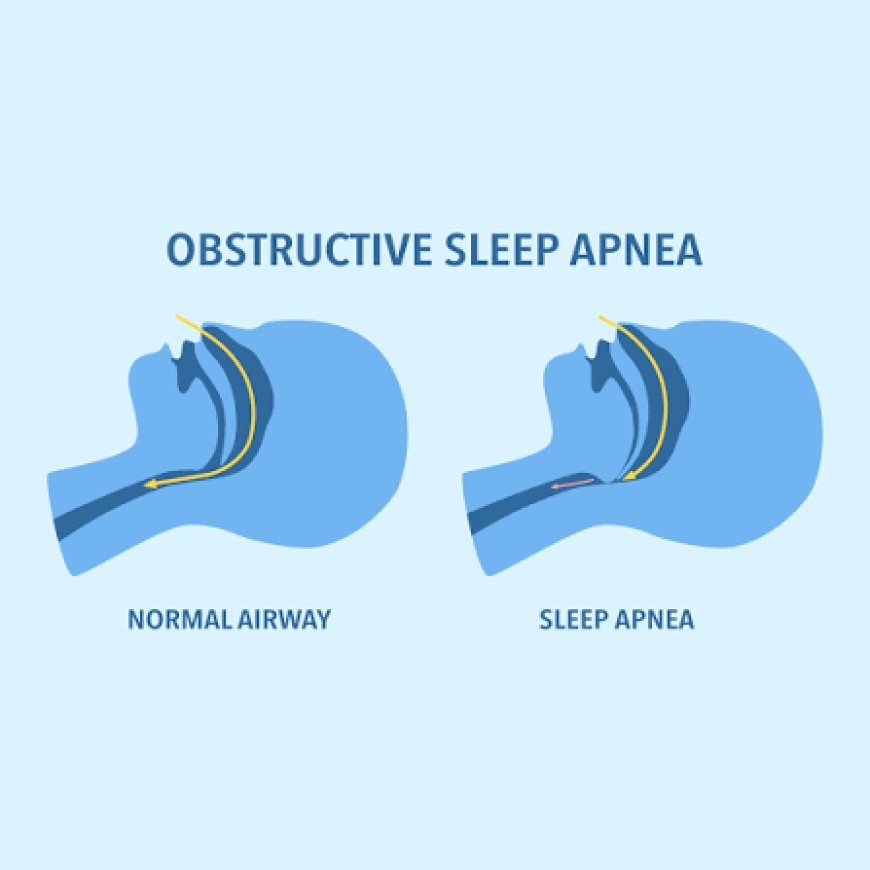 Sleep Apnea Implants Market Growth Driven by Rising Prevalence of Obstructive Sleep Apnea Worldwide