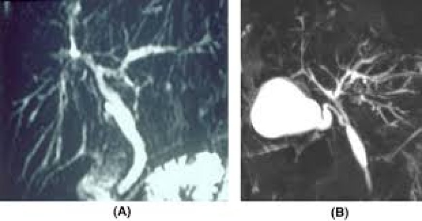 Primary Sclerosing Cholangitis Market Growth Driven by Increasing Research in Rare Liver Disease Treatments