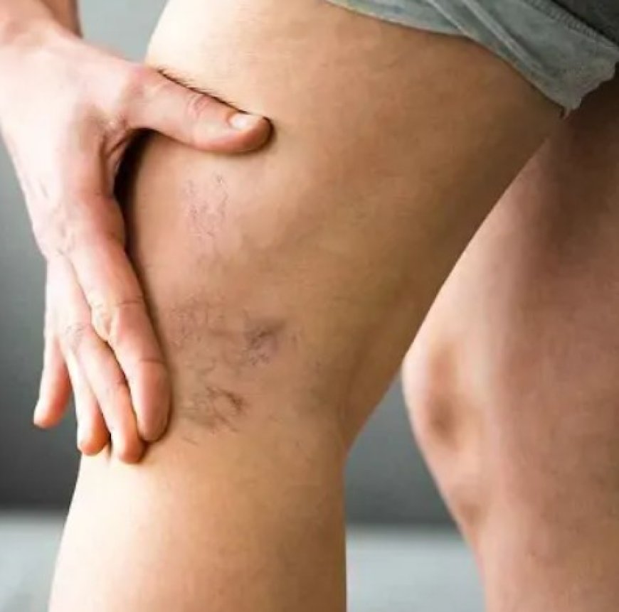 Varicose Veins Treatment In Dubai – Advanced Solutions for Smooth and Healthy Legs