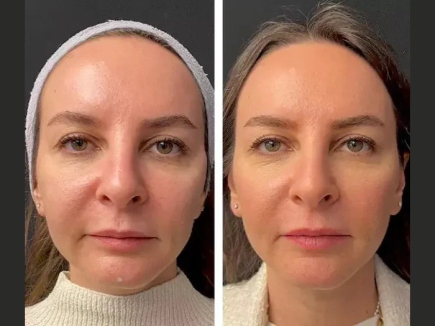 Best Aesthetic Clinics in Dubai: Is Mesotherapy Worth It for Anti-Aging?