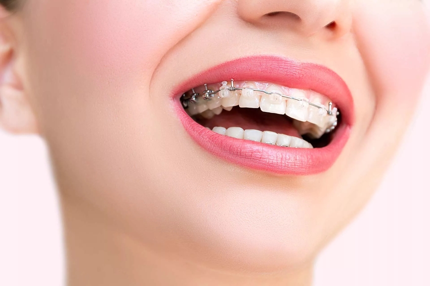 Braces Treatment in Tirupati: A Simple Guide for Pilgrims and Local Residents