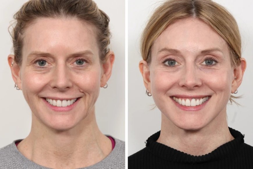 Best Plastic Surgeon in Dubai Explains Facial Lifting Without Surgery