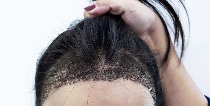 زراعة الشعر للنساء في بريدة