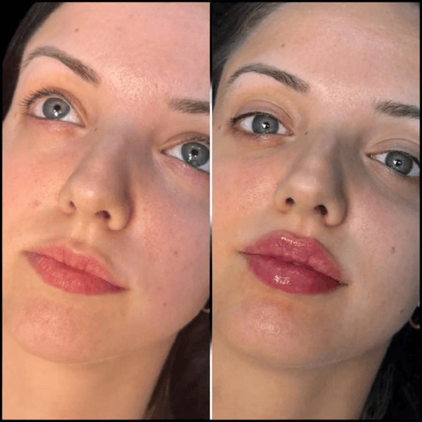 Best Doctors in dubai for Fillers: Offering High-End Aesthetic Care