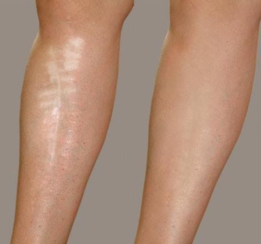 Post Surgical Scar Treatment in Dubai: Superior Skin Care