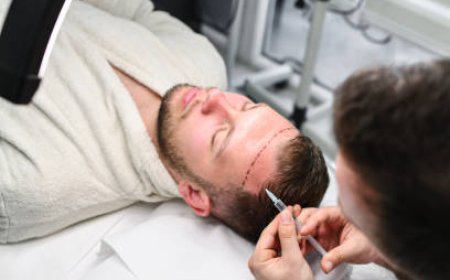 Hybrid Hair Transplant in Dubai: Planning Over 5000 Grafts