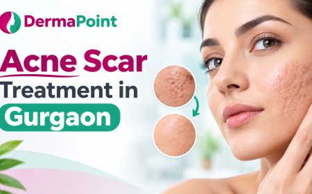 Acne Scar Removal Treatment Gurgaon: Why Treating Active Acne First Matters