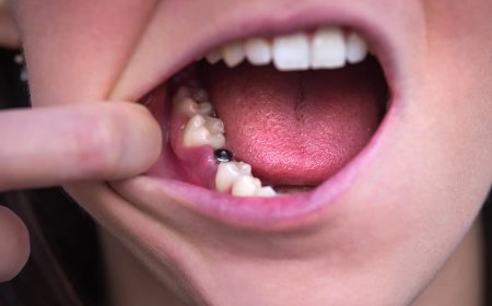 Are dental implants permanent?