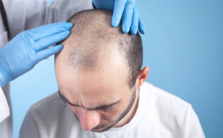 1 Dirham Hair Transplant in Dubai: Norwood Stage Cost Guide
