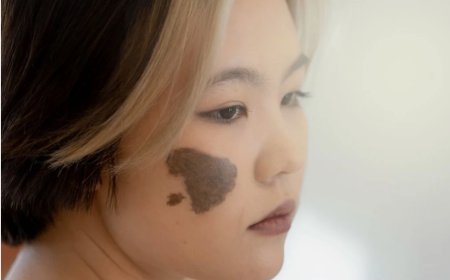 When Should a Birthmark Be Evaluated Before Cosmetic Removal?