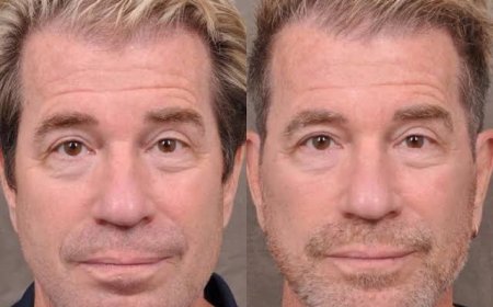 Thread Lift in Dubai to Support Long-Term Collagen Production