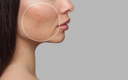 How to Maintain Results After Acne Scar Removal