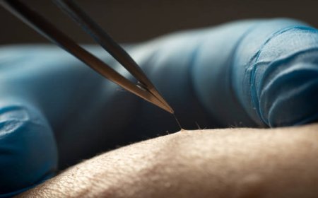 FUSS Hair Transplant in Dubai for Large Bald Areas