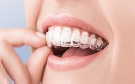 Clear Aligners in Hadapsar: Balancing Treatment with Work, Meals and Daily Life