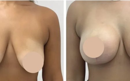 Breast Reduction in Dubai: Understanding the Benefits of Customized Breast Contouring