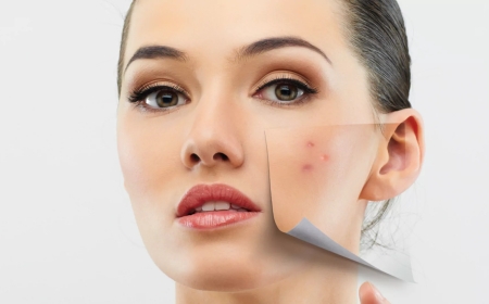 Pimples Treatment in Dubai for Whiteheads That Keep Returning