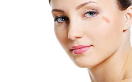 What are the benefits of Birthmarks Removal?