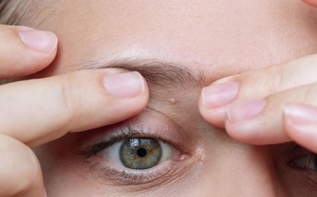 Is treatment necessary for milia?
