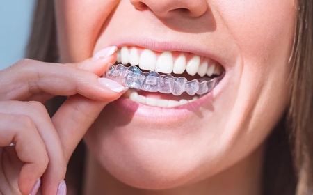 Invisalign Dentist NW Calgary: Guide to Clear Aligners