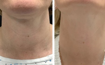 Best Doctors in dubai for Radiofrequency Microneedling Natural-Looking Results