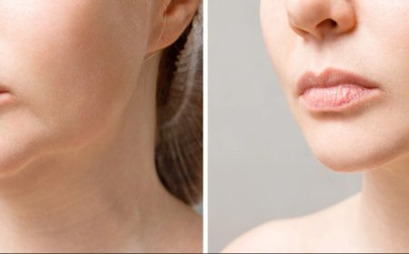 How to Prepare for a Smooth Chin Reduction Recovery