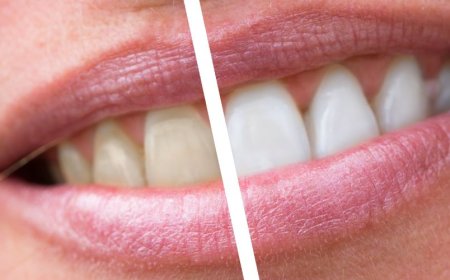 Why Do Some Teeth Respond Better to Professional Whitening Than Others?