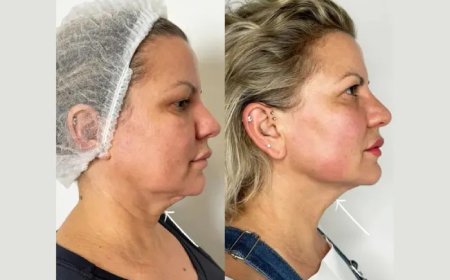 Endolift in dubai for Enhancing Lower Face Definition and Firmness