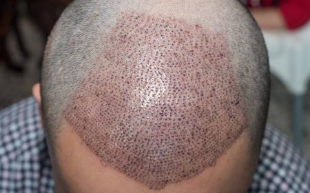 Is FUE Hair Transplant suitable for everyone?
