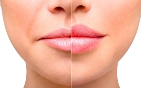 Factors That Influence the Cost of Russian Lip Fillers in Jeddah