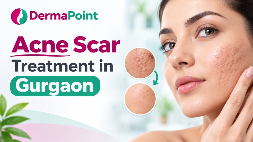 Acne Scar Removal Treatment Gurgaon: Why Treating Active Acne First Matters