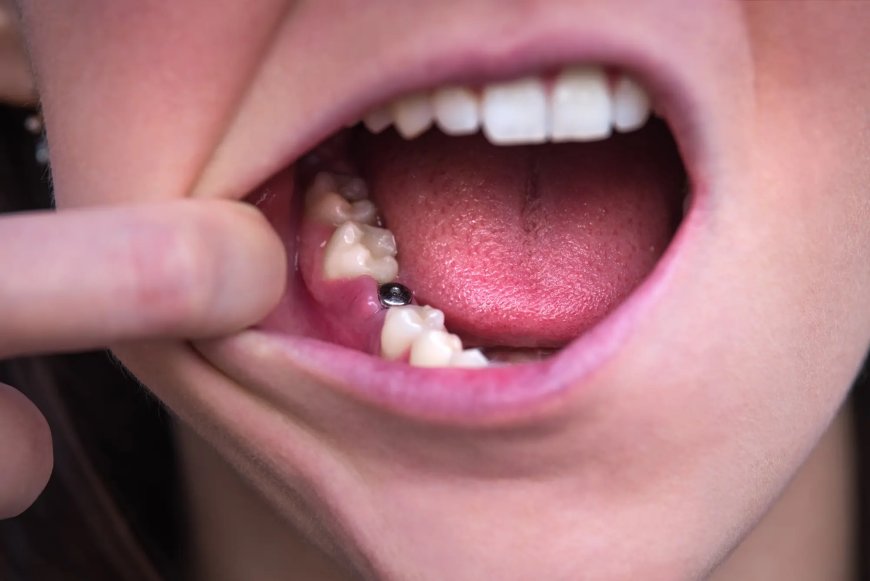 Are dental implants permanent?