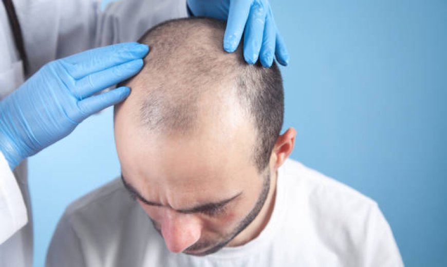 1 Dirham Hair Transplant in Dubai: Norwood Stage Cost Guide