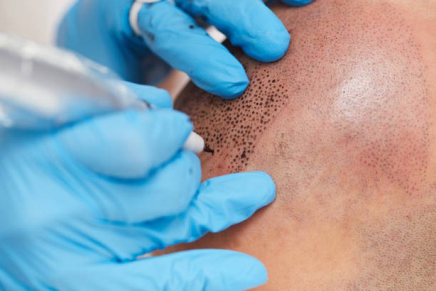 Scalp Micropigmentation in Dubai for Temple Definition Guide