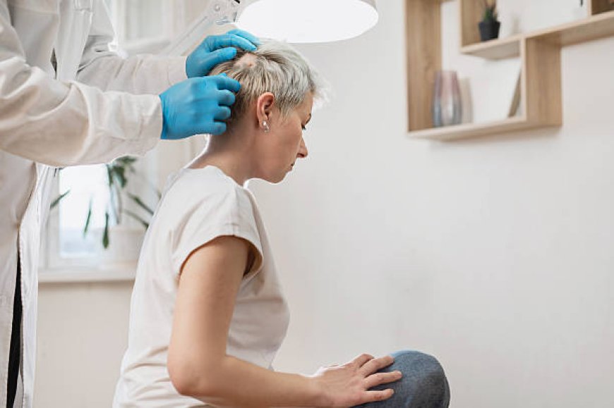 Alopecia Areata Treatment in Dubai for Scalp-Only Patches