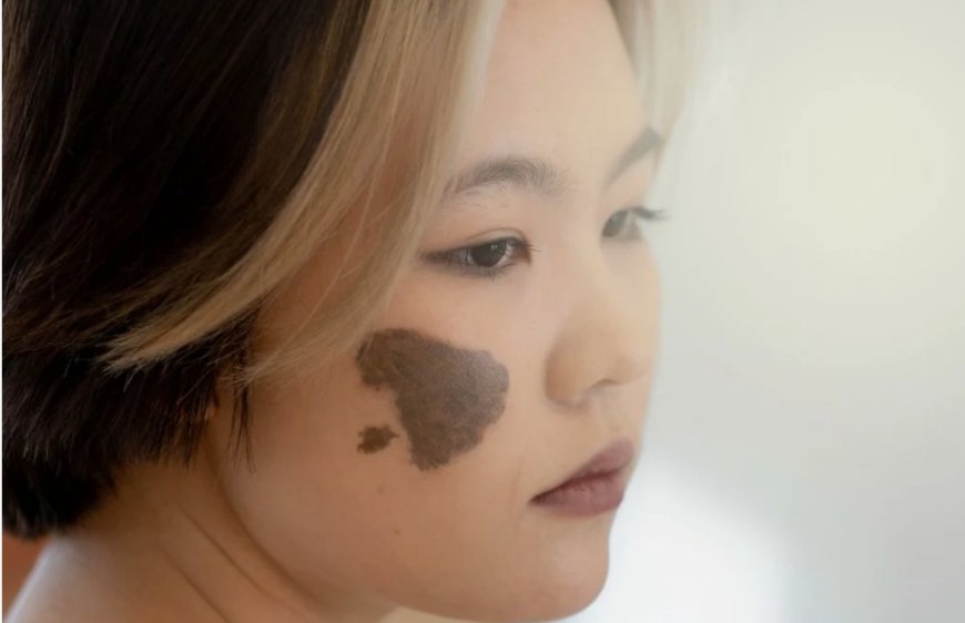 When Should a Birthmark Be Evaluated Before Cosmetic Removal?