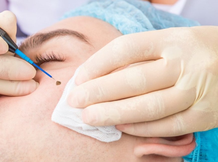 How does a dermatologist examine a mole?