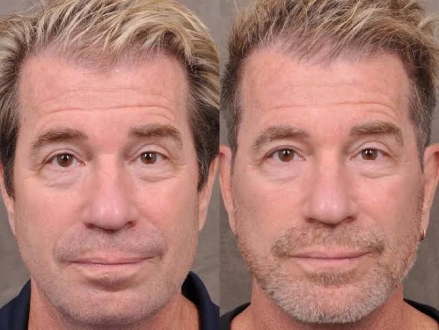 Thread Lift in Dubai to Support Long-Term Collagen Production