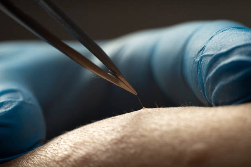 FUSS Hair Transplant in Dubai for Large Bald Areas