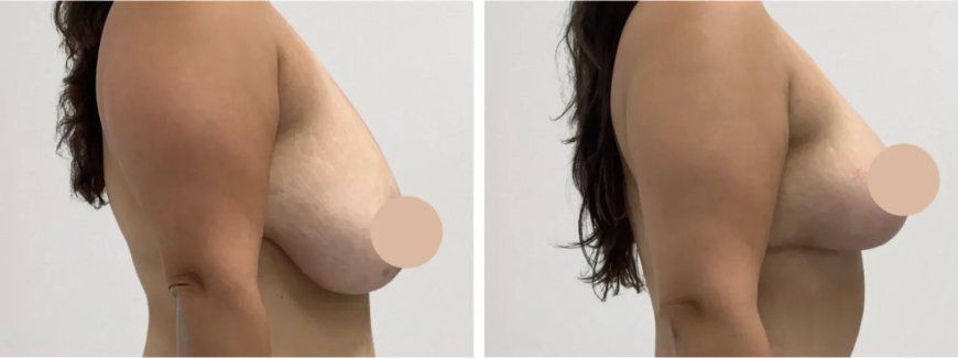 Breast Lift in Dubai for Restoring a Youthful Breast Position With Customized Techniques