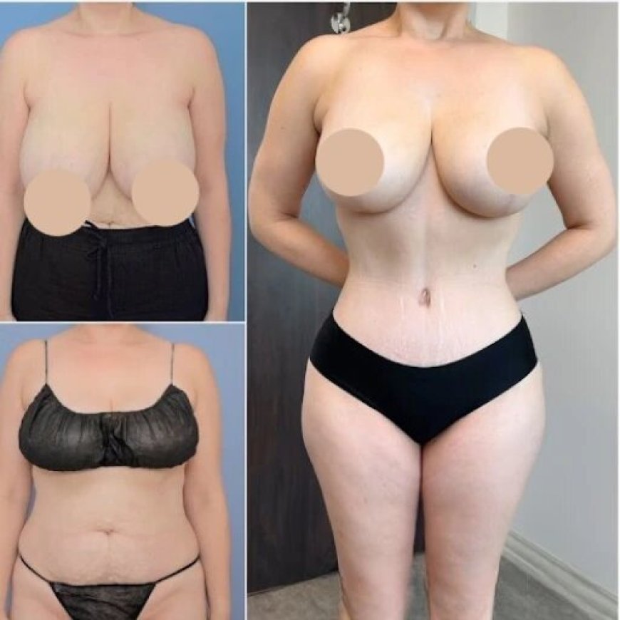 Tummy Tuck in Dubai: Precision Body Contouring for a Refined Look