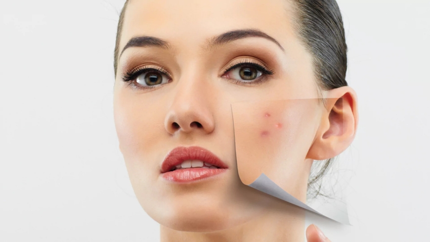 Pimples Treatment in Dubai for Whiteheads That Keep Returning